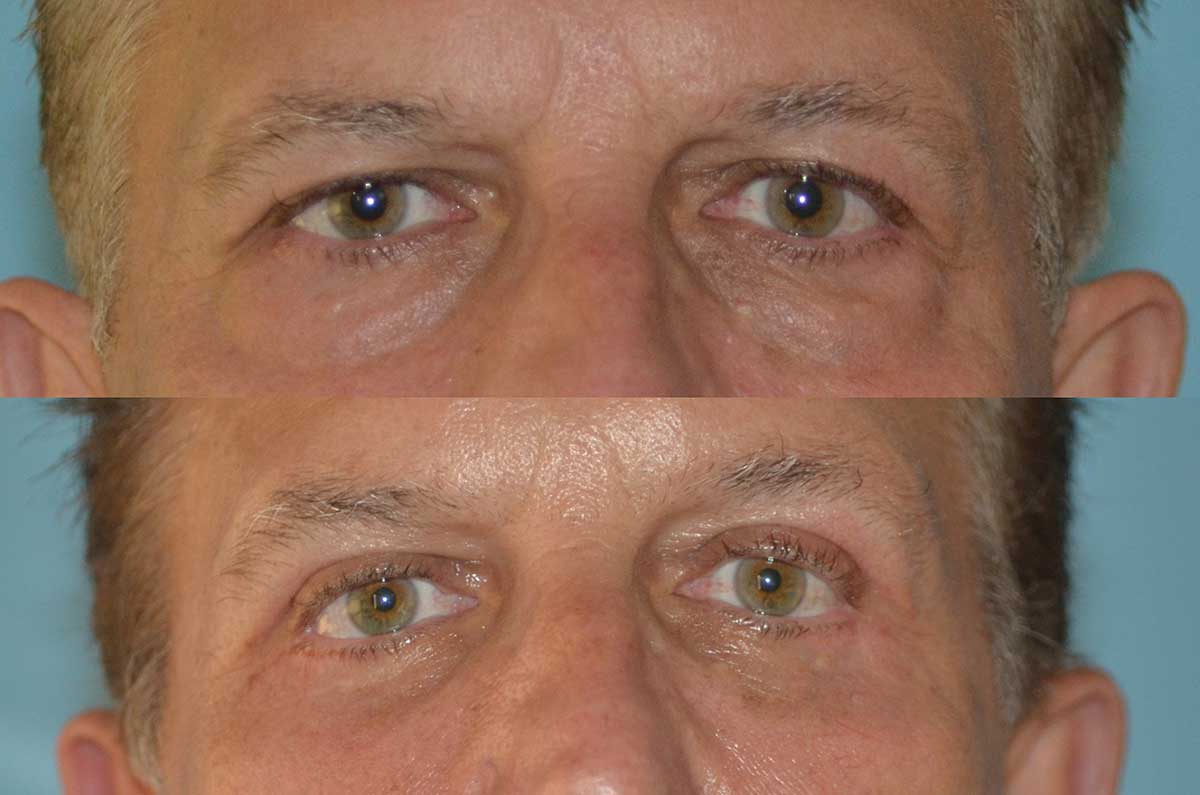 denver eyelid surgery