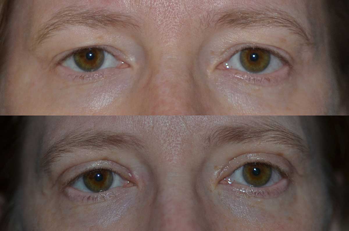 denver eyelid surgery