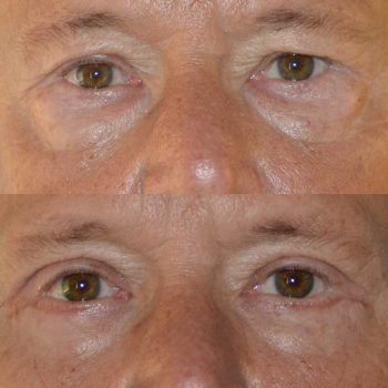 denver eyelid surgery