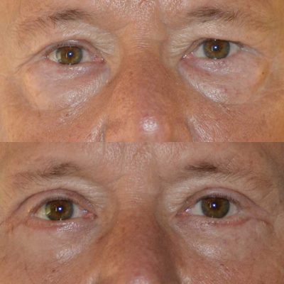 denver eyelid surgery