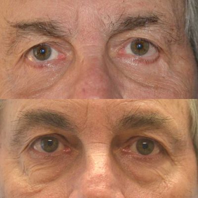denver eyelid surgery