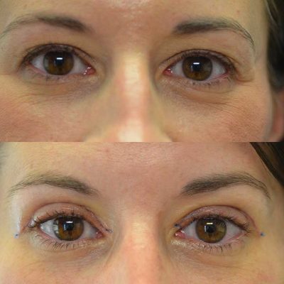 denver eyelid surgery
