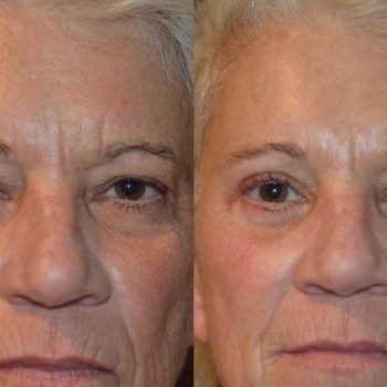 Before_After-3_2