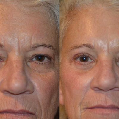 Before_After-3_2