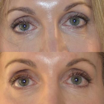 denver eyelid surgery
