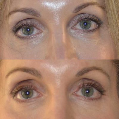 denver eyelid surgery