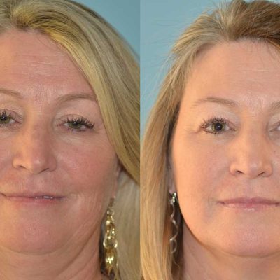 denver eyelid surgery