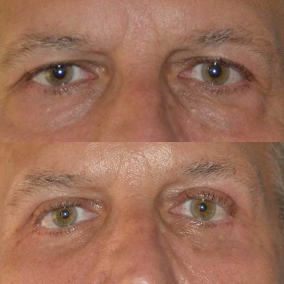 denver eyelid surgery