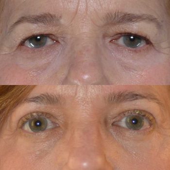 denver eyelid surgery
