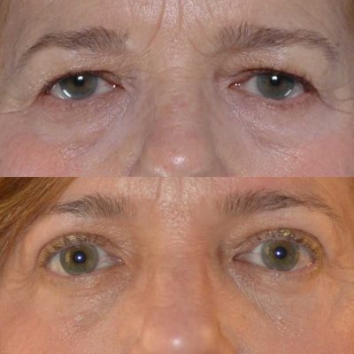 denver eyelid surgery