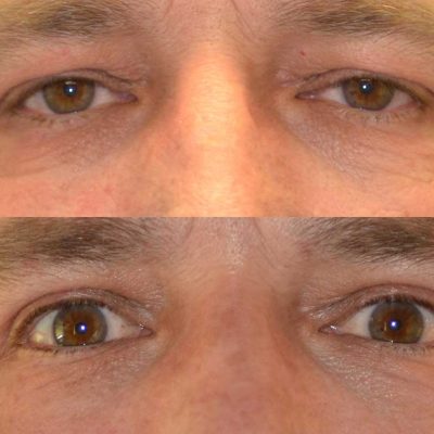 denver eyelid surgery