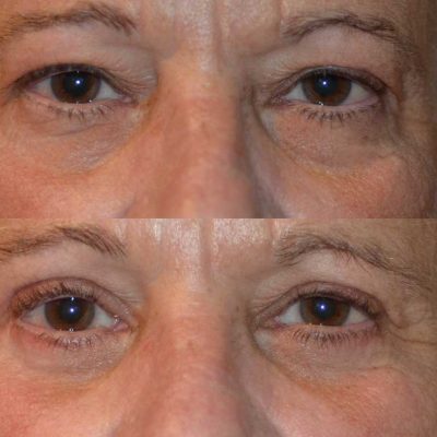 denver eyelid surgery